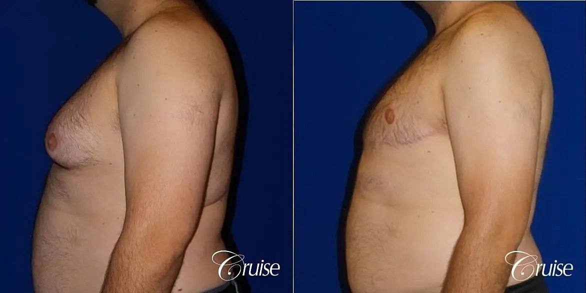 Gynecomastia Before & After