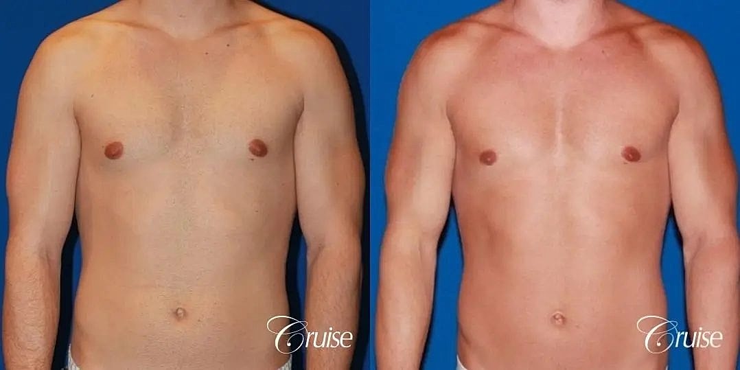 Gynecomastia Before & After