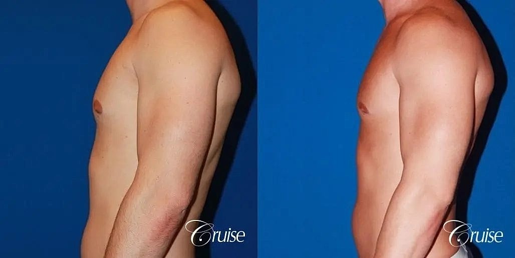 Gynecomastia Before & After