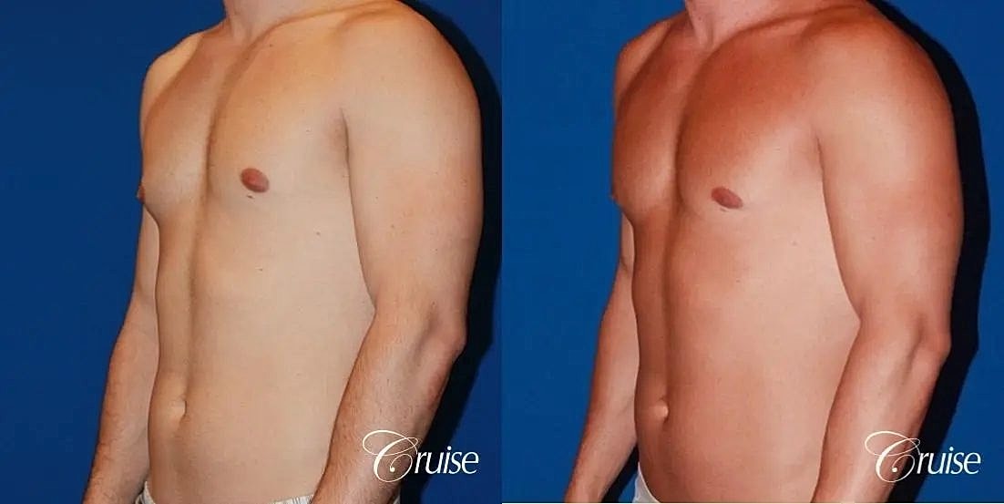 Gynecomastia Before & After