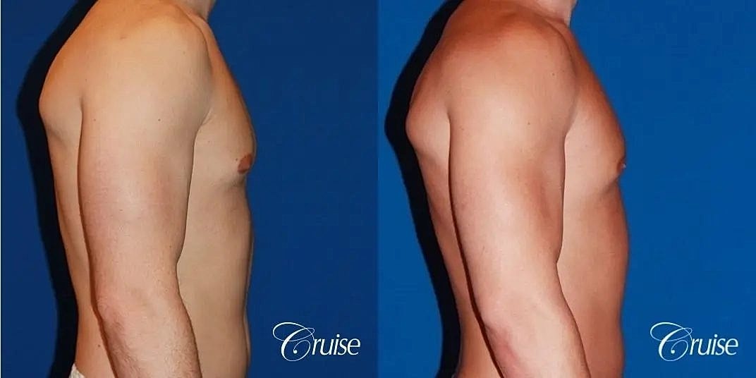 Gynecomastia Before & After