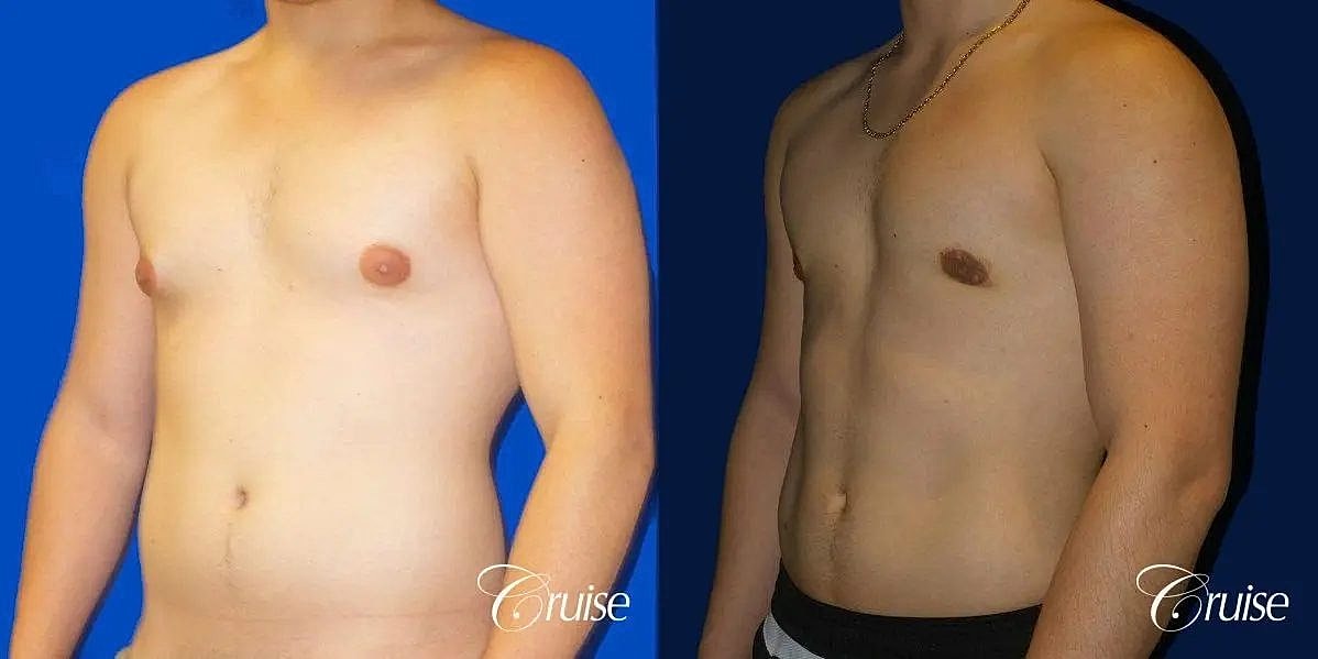 Gynecomastia Before & After