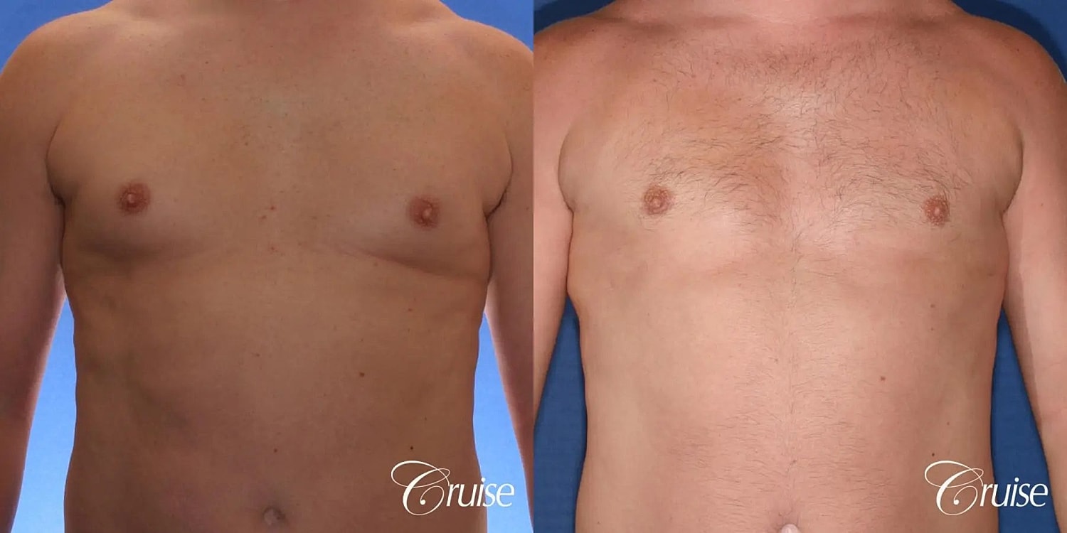 Gynecomastia Before & After