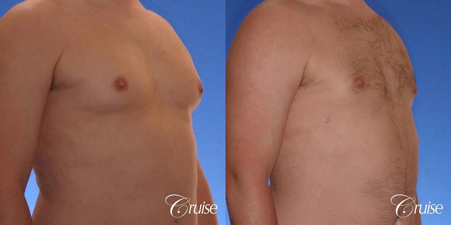 Gynecomastia Before & After