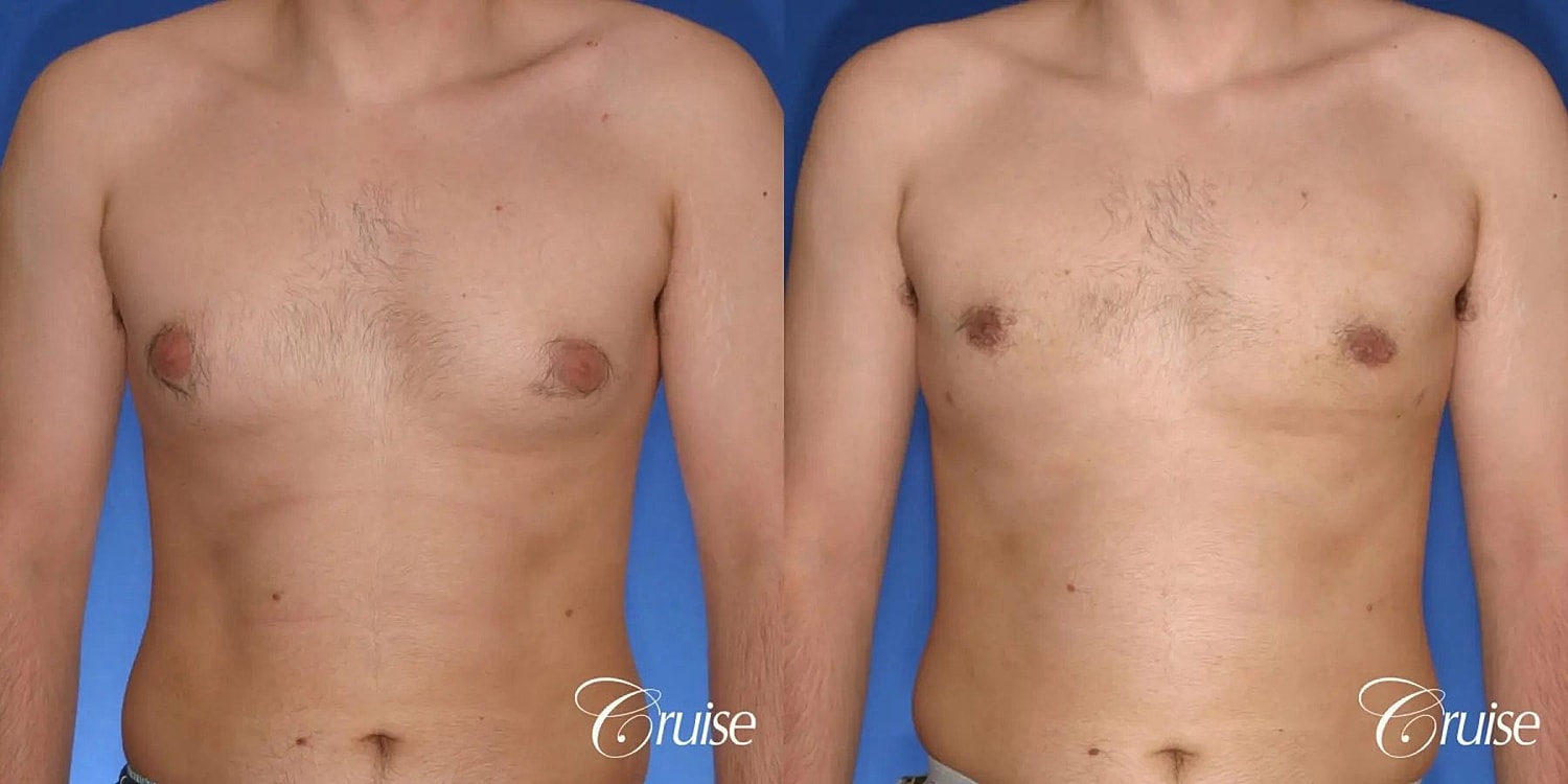 Gynecomastia Before & After