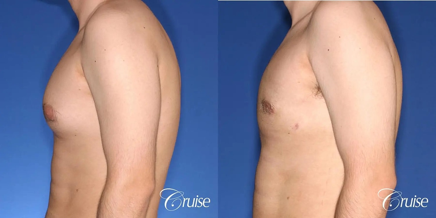 Gynecomastia Before & After