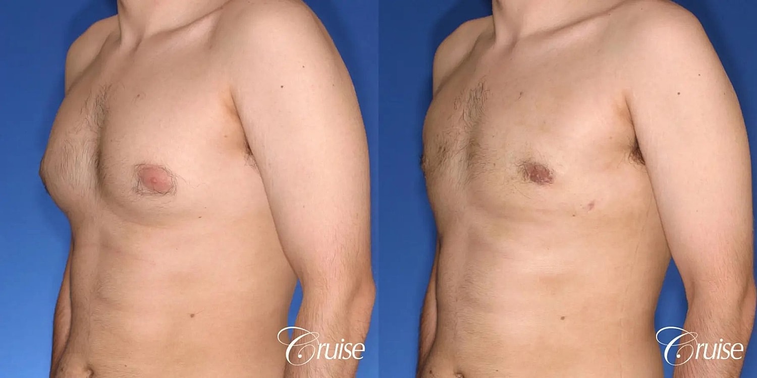 Gynecomastia Before & After