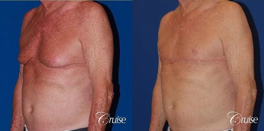 Gynecomastia Before & After