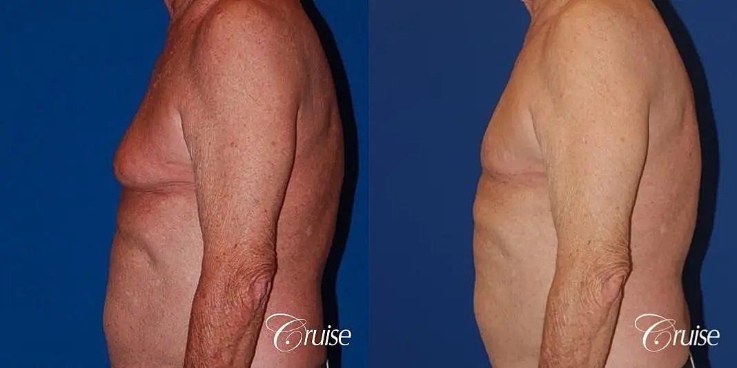 Gynecomastia Before & After