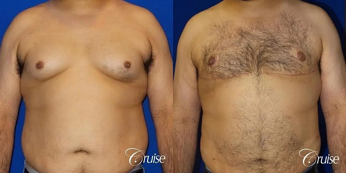 Gynecomastia Before & After