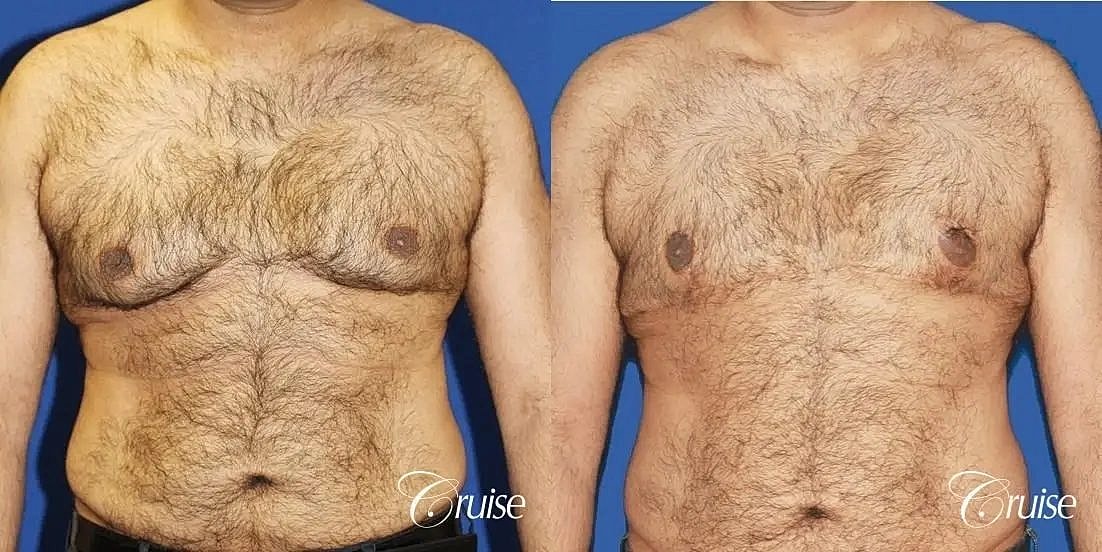 Gynecomastia Before & After
