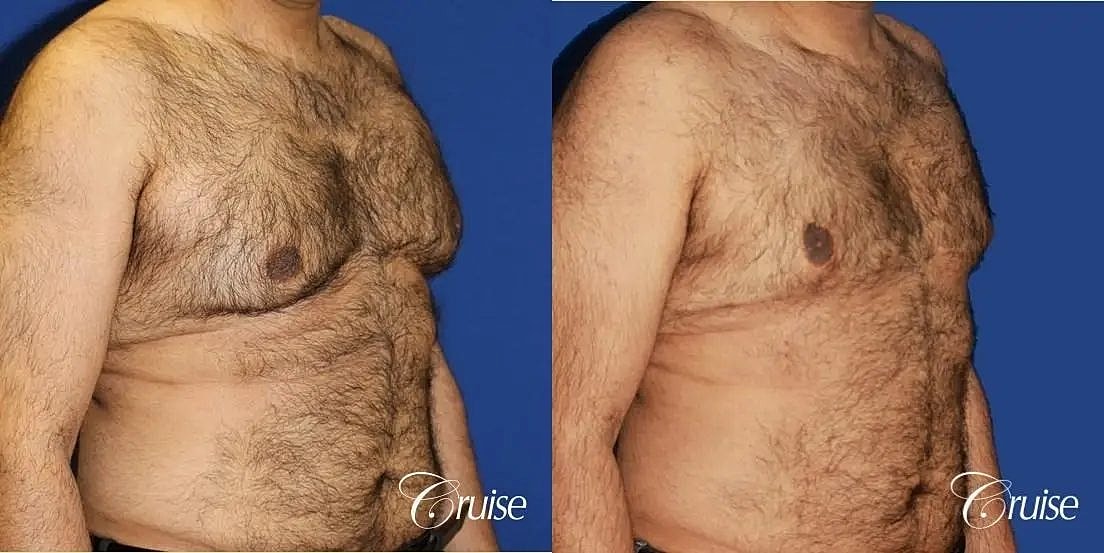 Gynecomastia Before & After