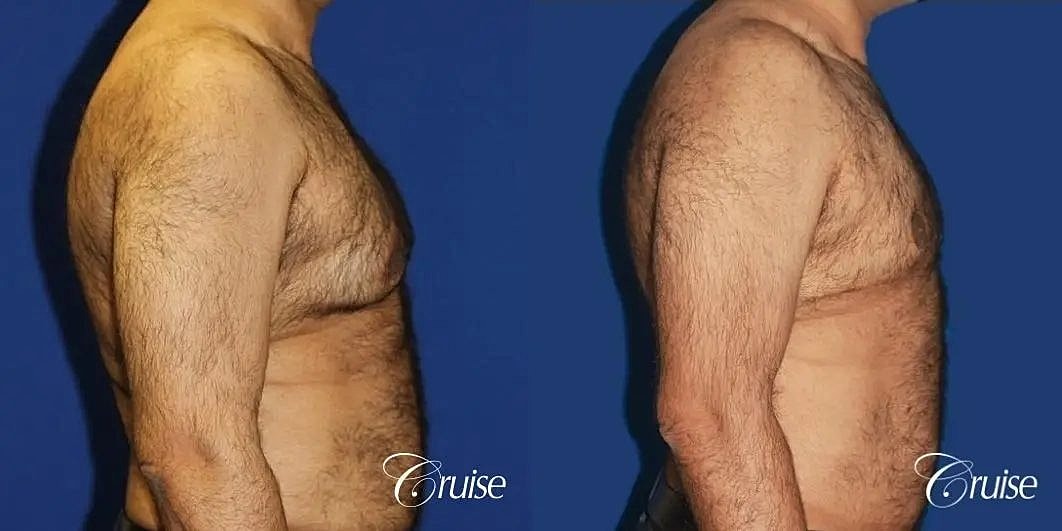 Gynecomastia Before & After