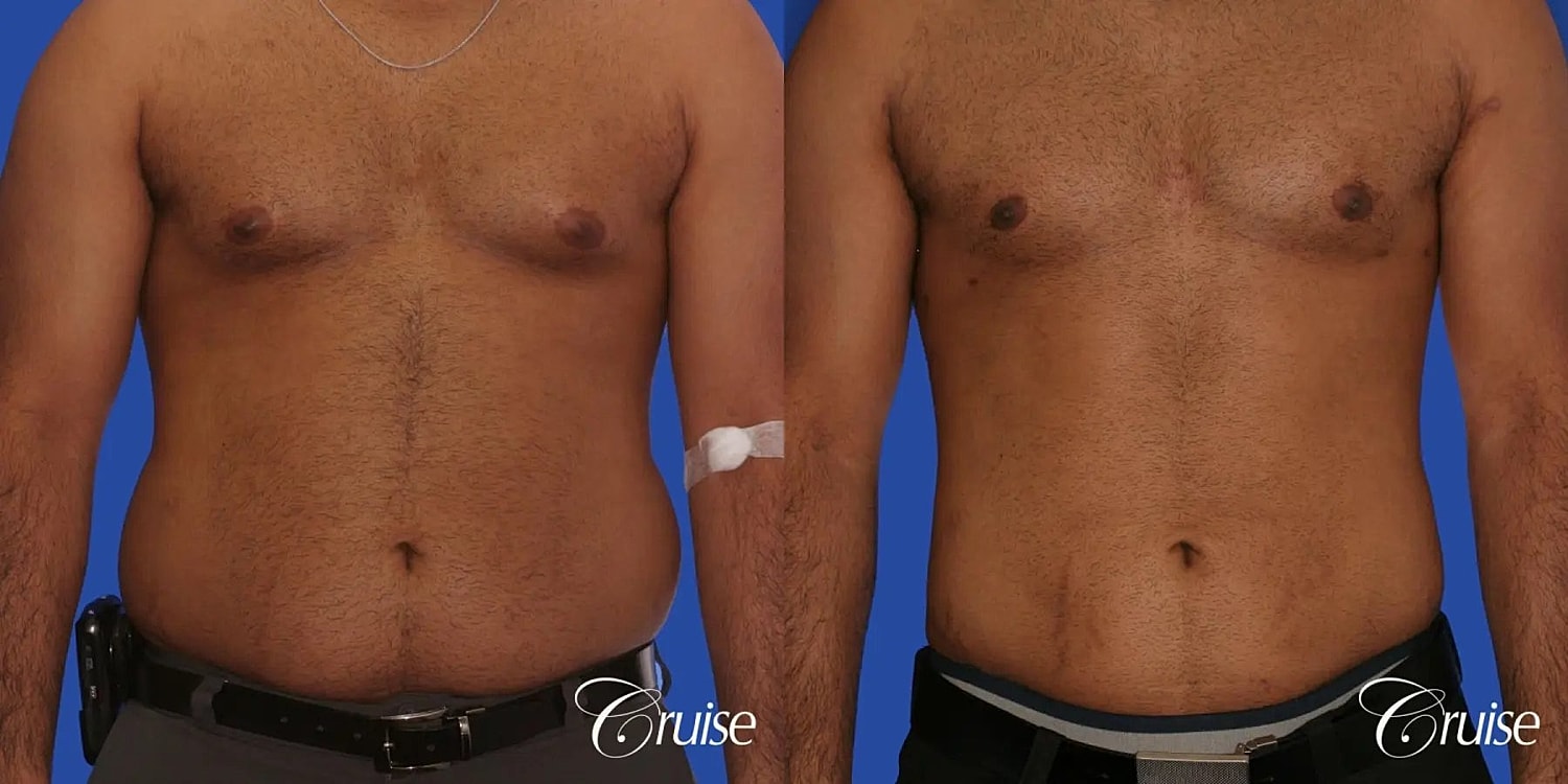Gynecomastia Before & After