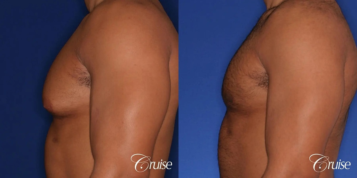 Gynecomastia Before & After