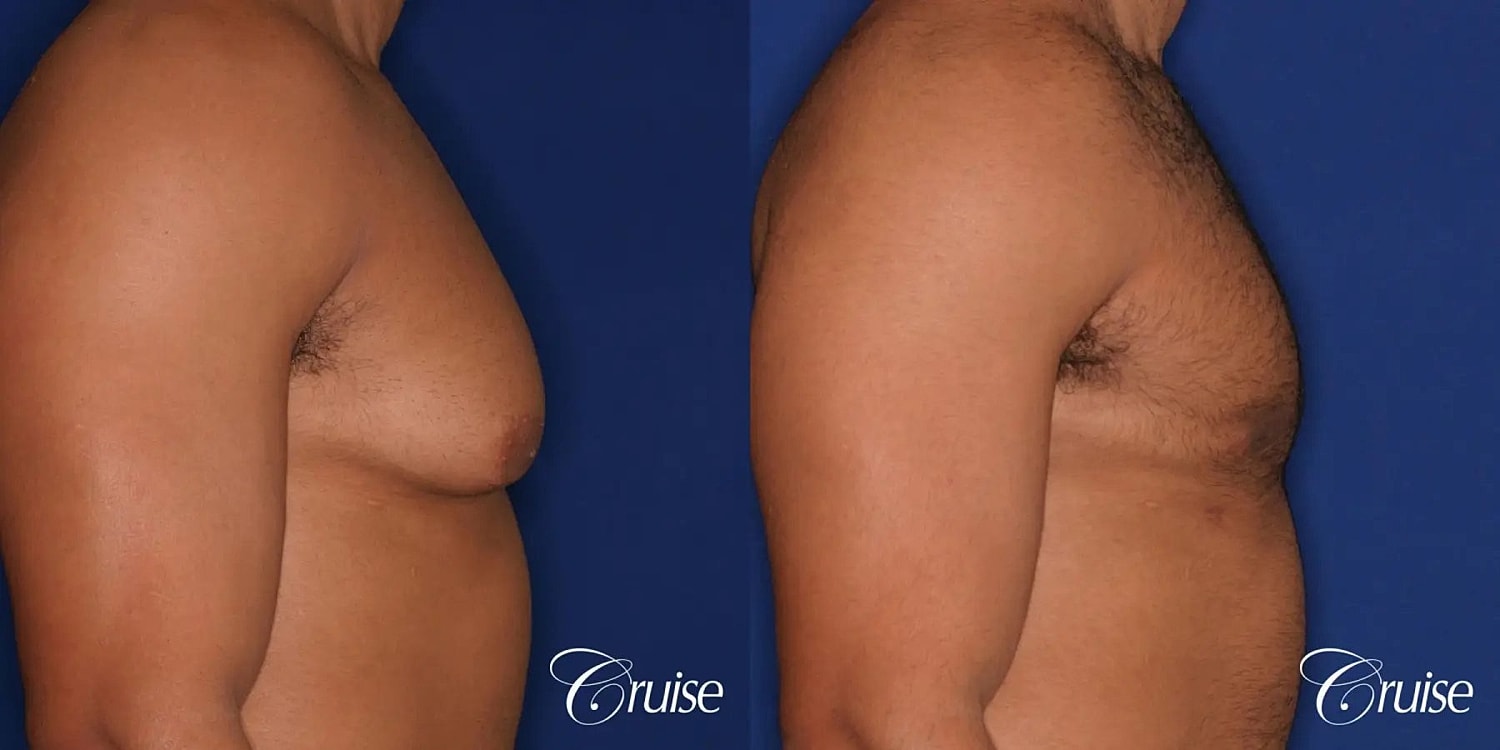 Gynecomastia Before & After