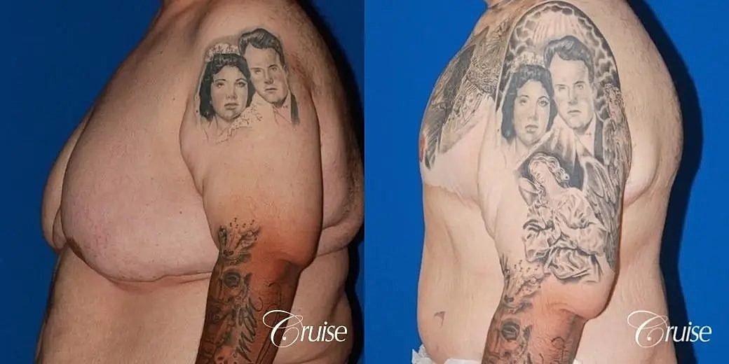 Gynecomastia Before & After