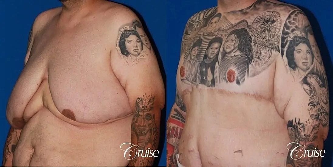 Gynecomastia Before & After