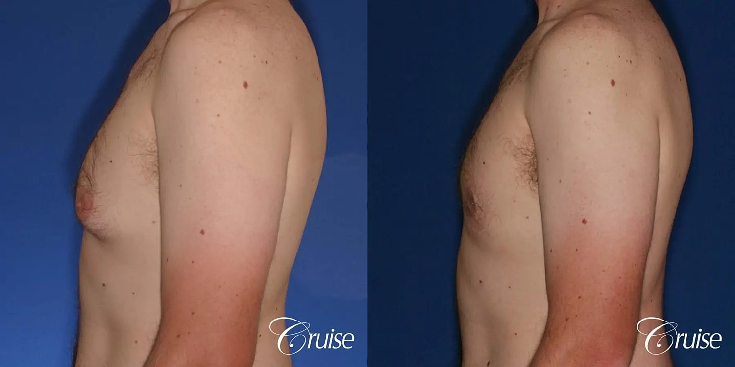 Gynecomastia Before & After