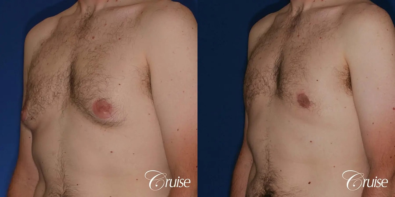 Gynecomastia Before & After