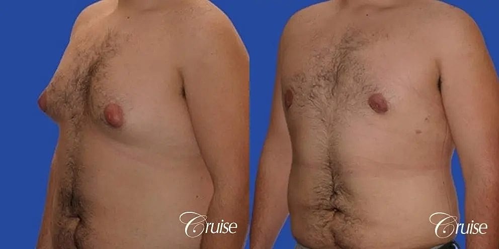 Gynecomastia Before & After