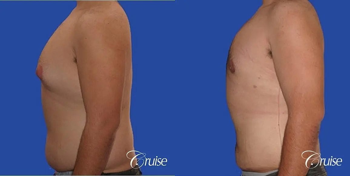 Gynecomastia Before & After