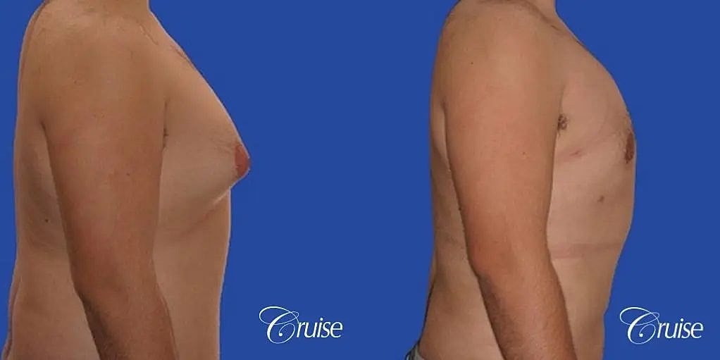 Gynecomastia Before & After