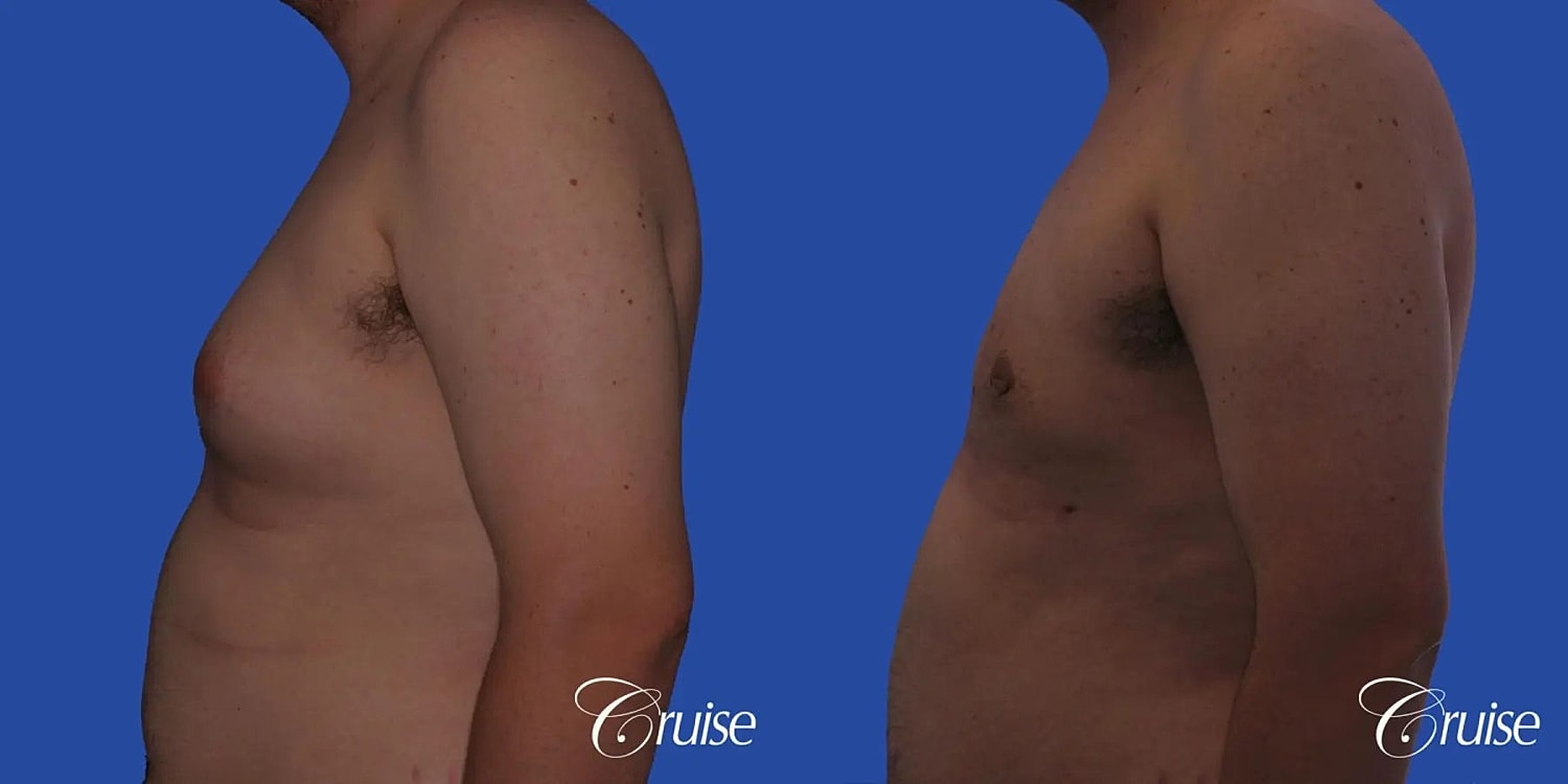 Gynecomastia Before & After