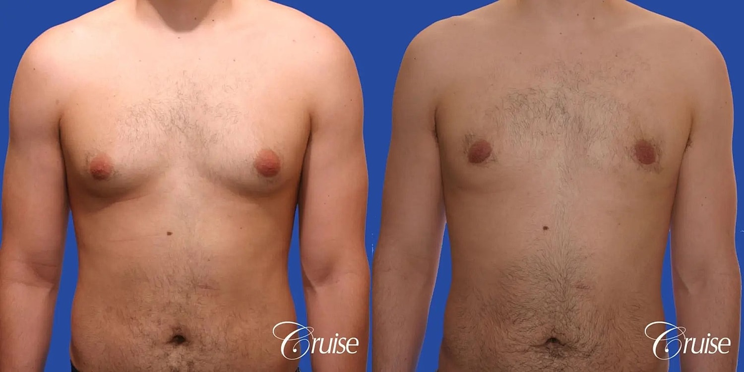 Gynecomastia Before & After