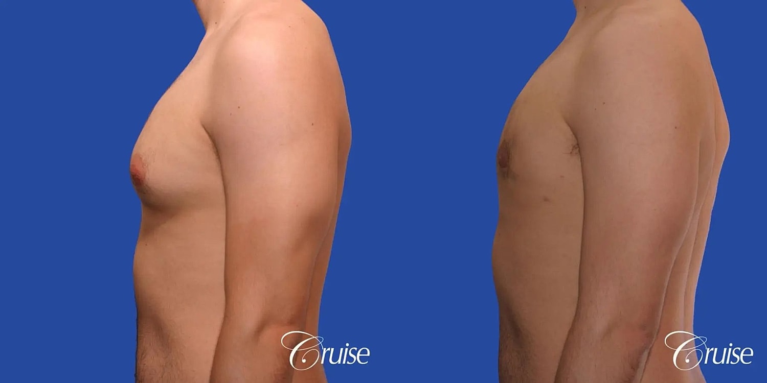 Gynecomastia Before & After