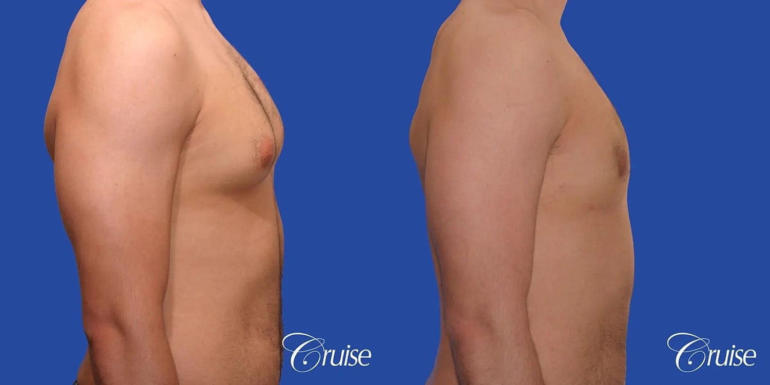 Gynecomastia Before & After