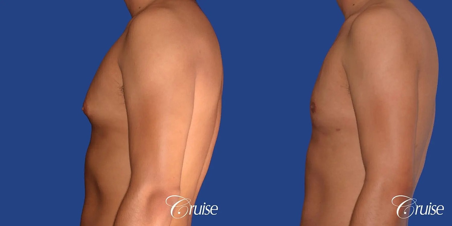 Gynecomastia Before & After