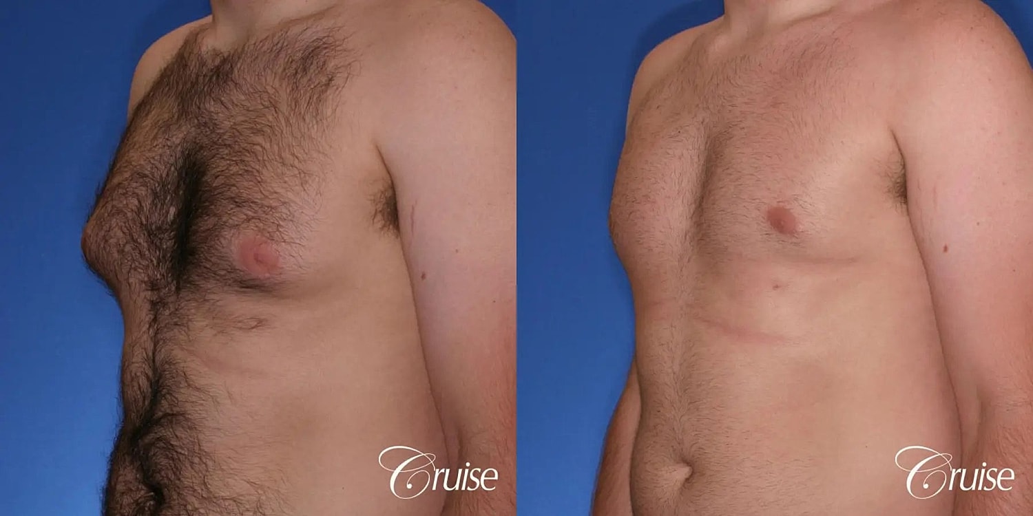 Gynecomastia Before & After