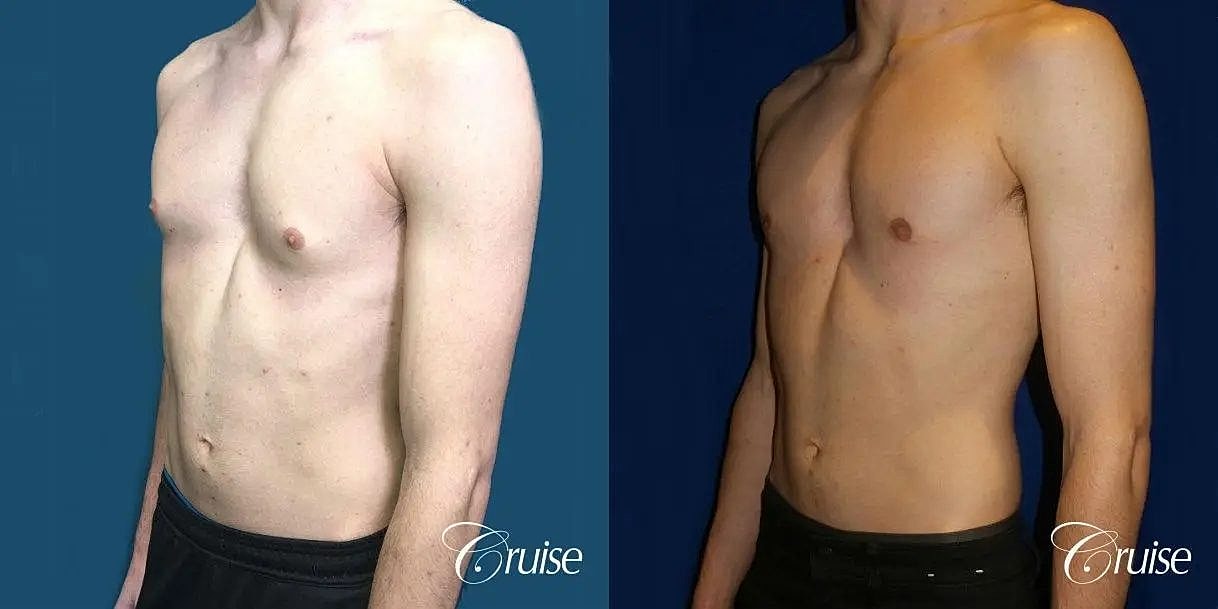 Gynecomastia Before & After