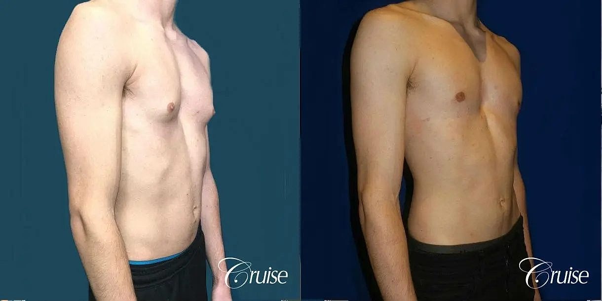 Gynecomastia Before & After