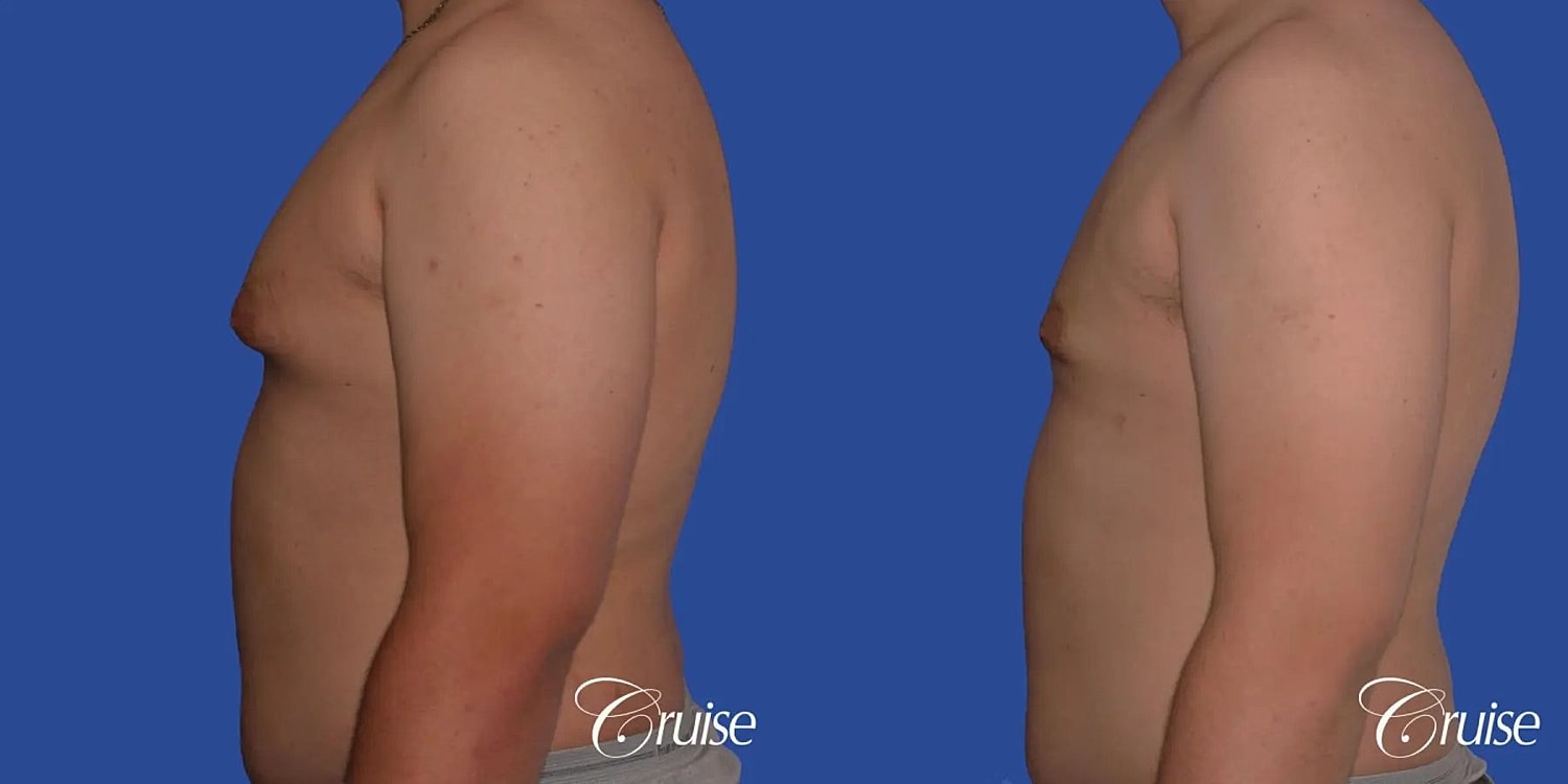 Gynecomastia Before & After
