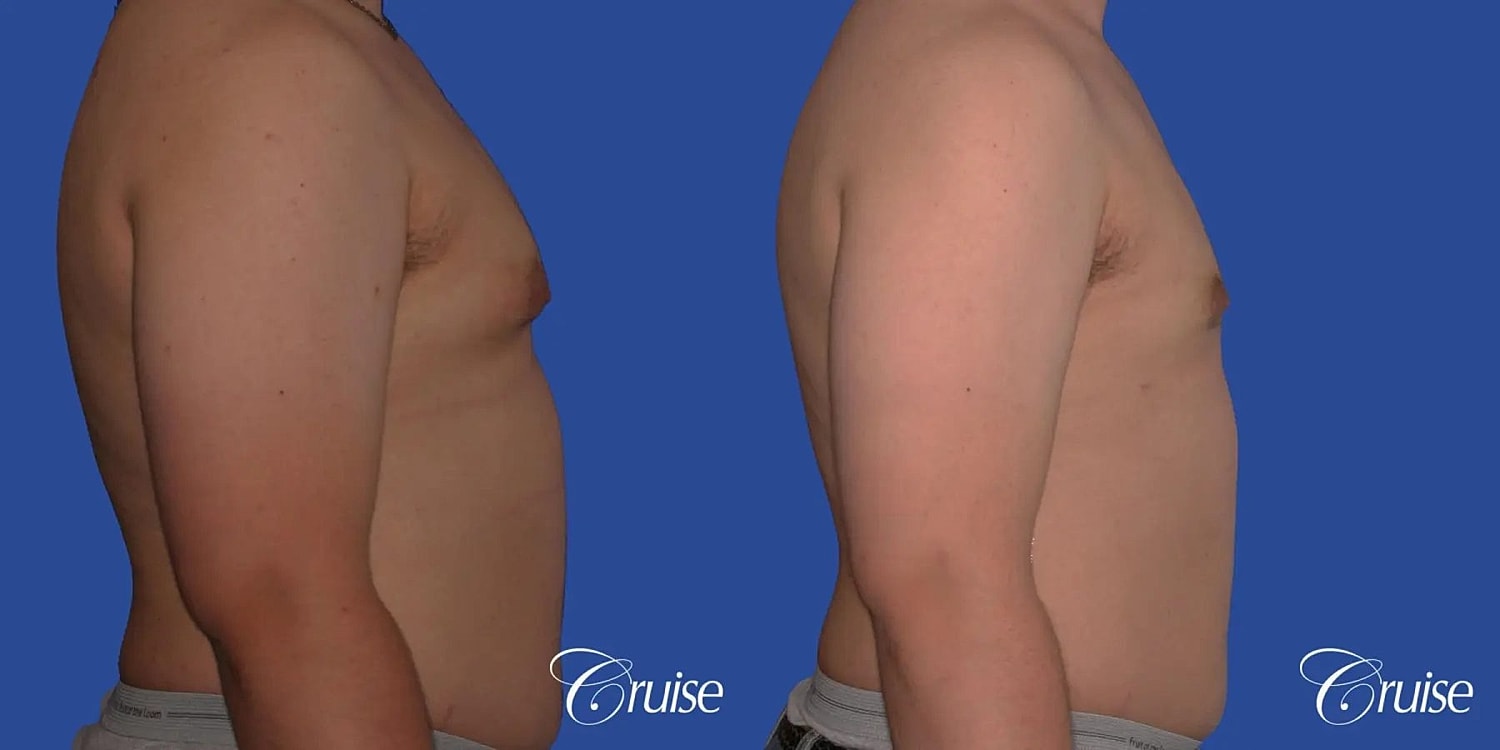 Gynecomastia Before & After