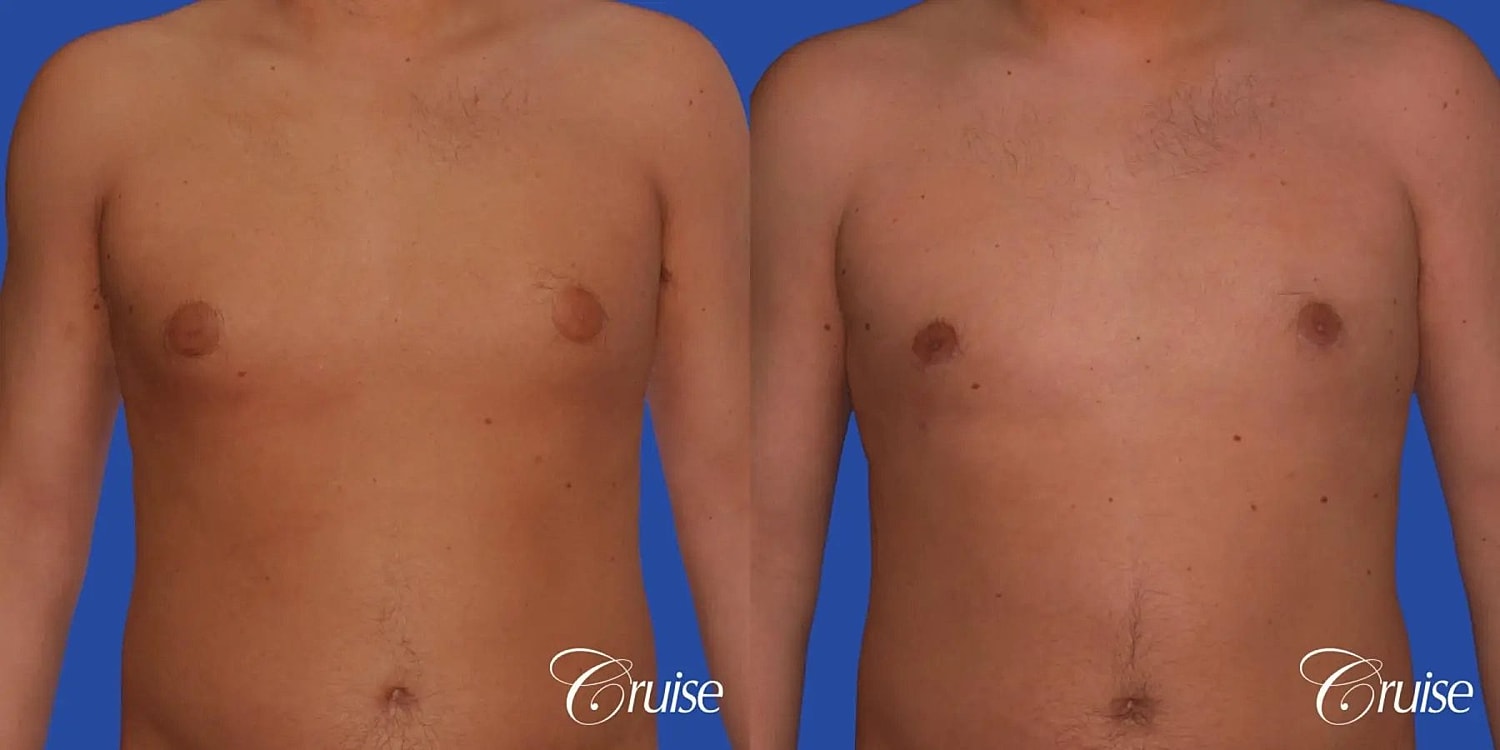 Gynecomastia Before & After
