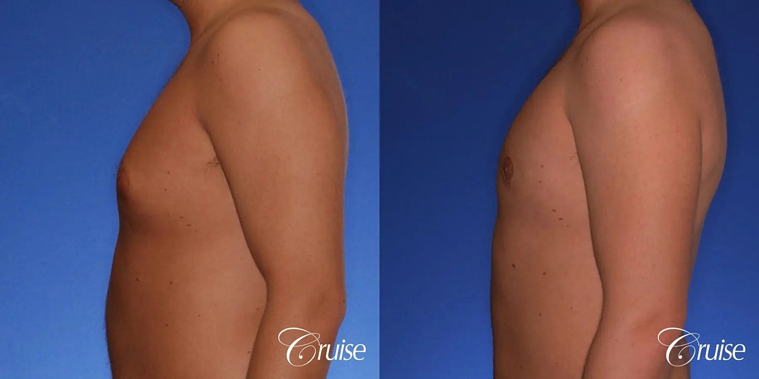 Gynecomastia Before & After