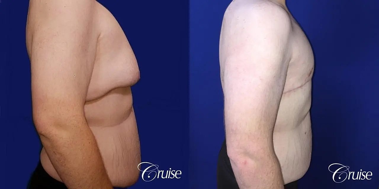 Gynecomastia Before & After
