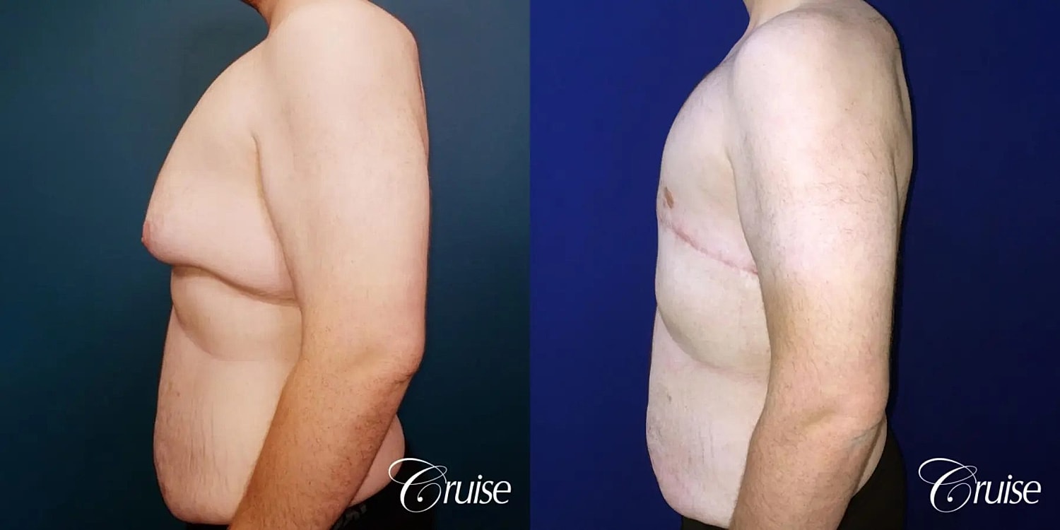 Gynecomastia Before & After