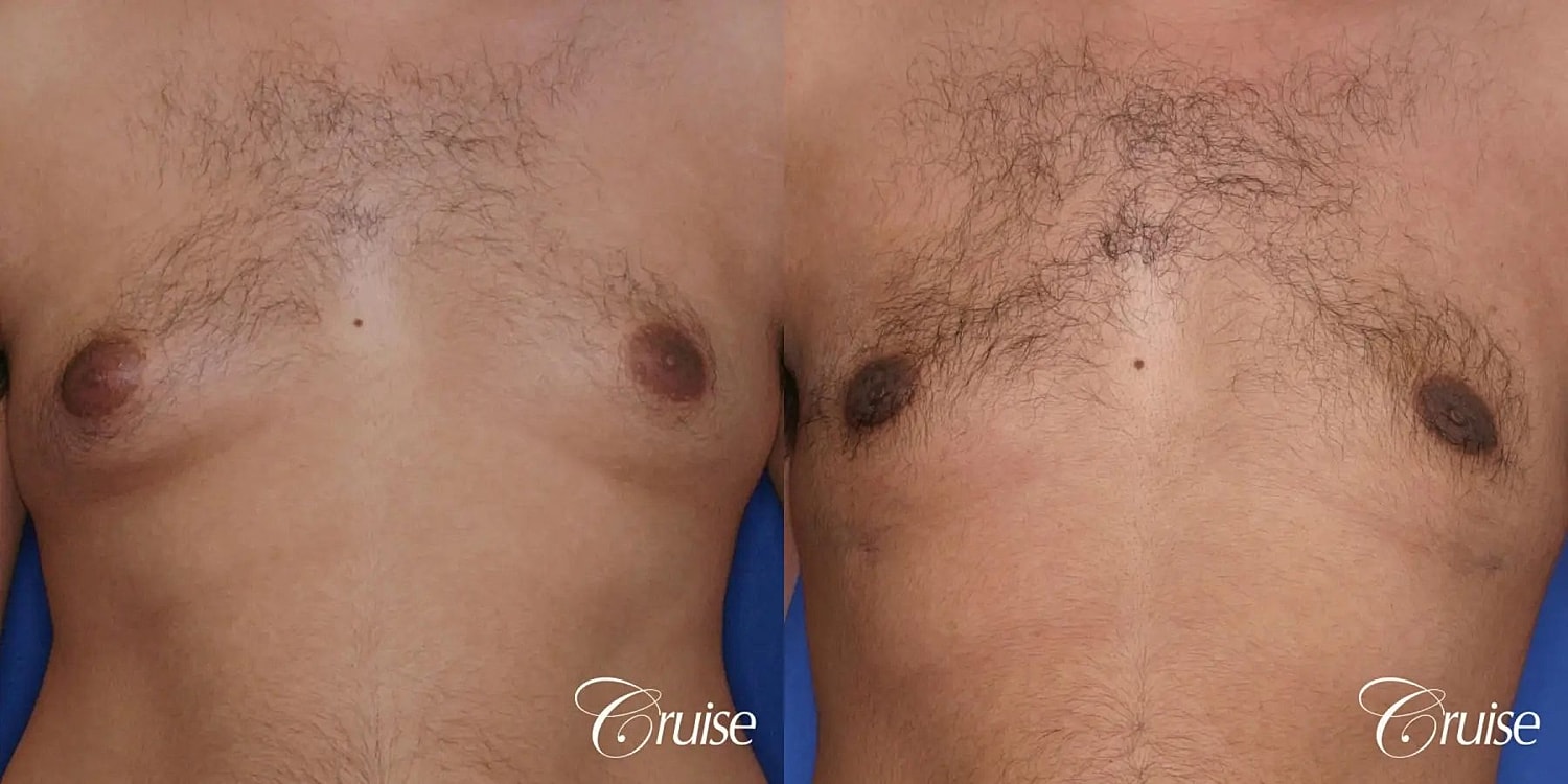 Gynecomastia Before & After