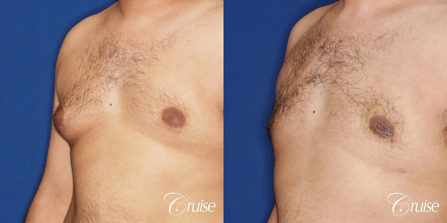 Gynecomastia Before & After