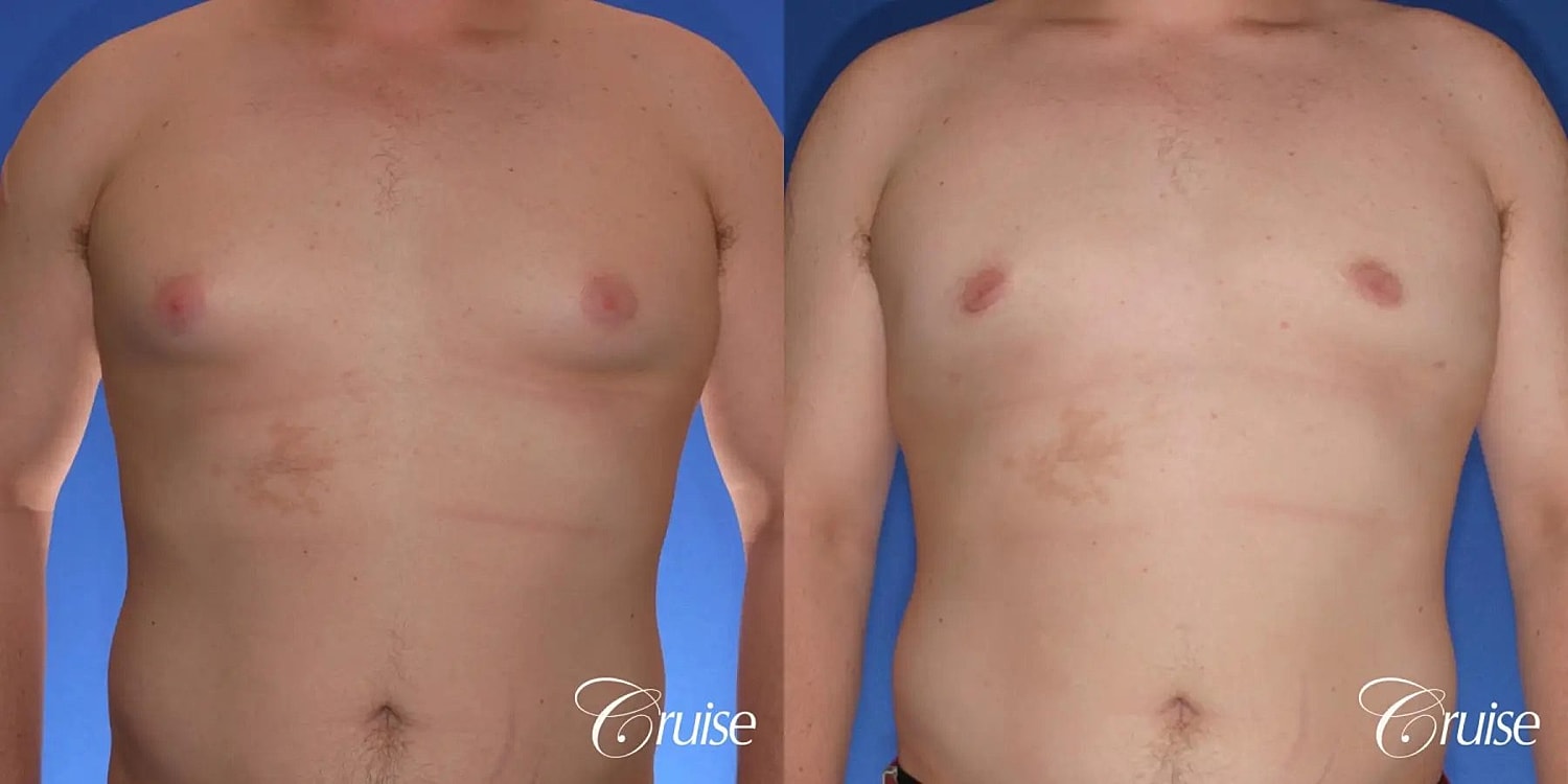 Gynecomastia Before & After