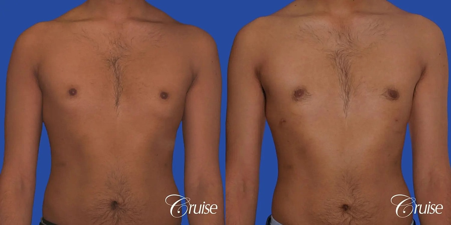 Gynecomastia Before & After