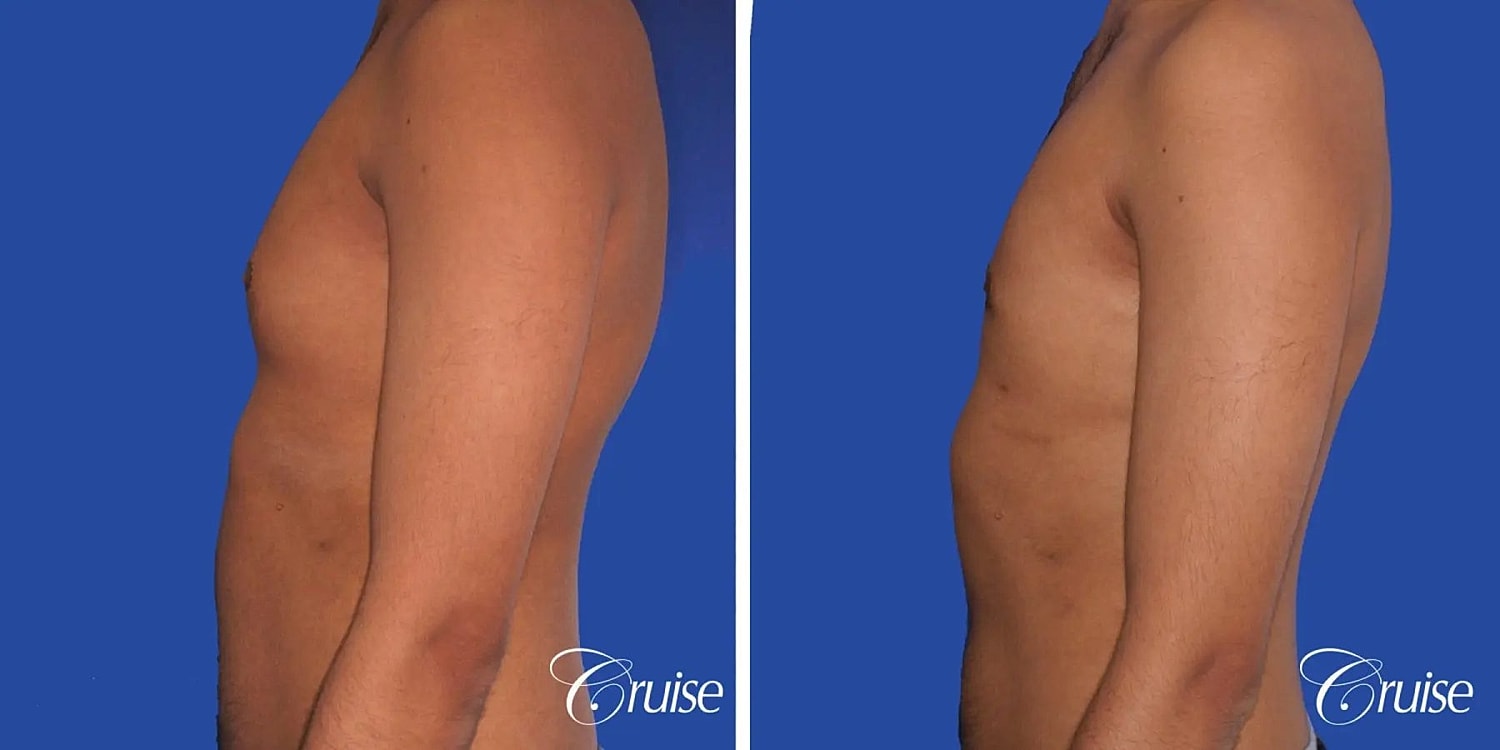 Gynecomastia Before & After