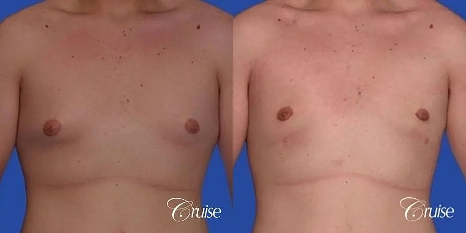 Gynecomastia Before & After