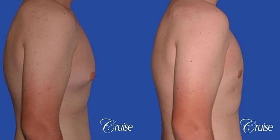 Gynecomastia Before & After