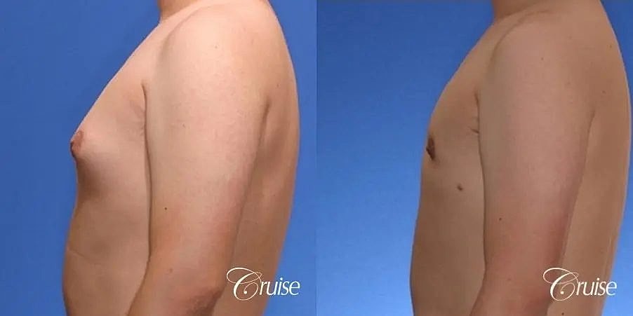 Gynecomastia Before & After