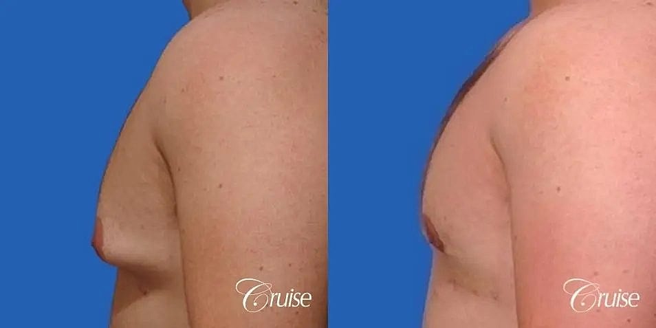 Gynecomastia Before & After
